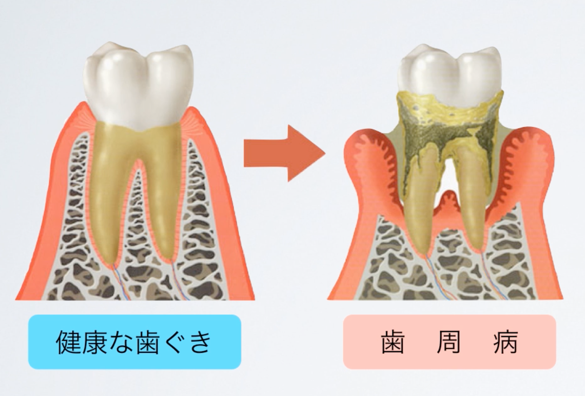 歯 の ぐらつき 治る